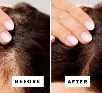 Hair Fall Treatment