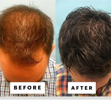 Hair Regrow Treatment