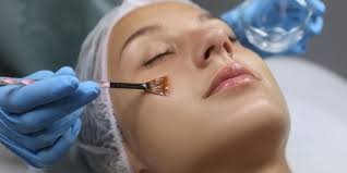 Chemical Peel Treatment in Greater Noida