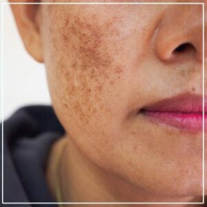 Pigmentation & Blemishes