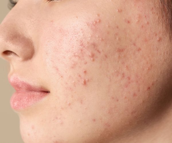 Acne Treatment in Noida