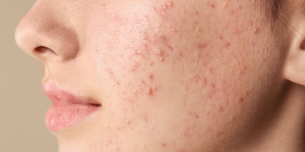 Acne Treatment in Noida