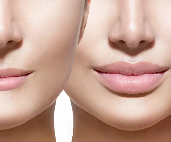 Dermal Fillers Treatment in Noida