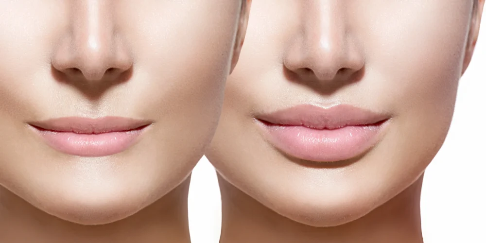 Dermal Fillers Treatment in Noida