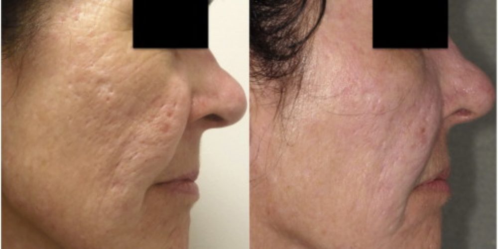Microneedling