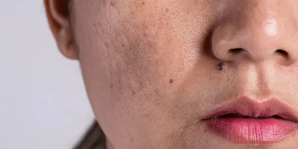 pigmentation treatment in noida
