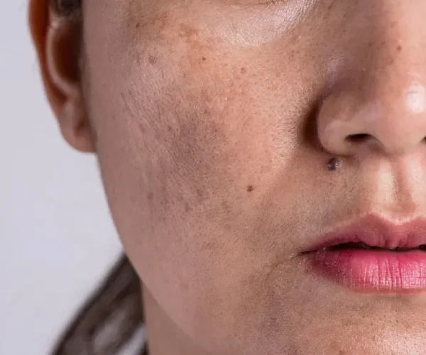 pigmentation treatment in noida