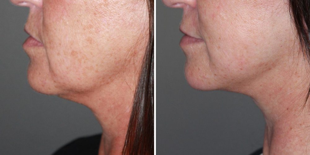 Skin rejuvenation
