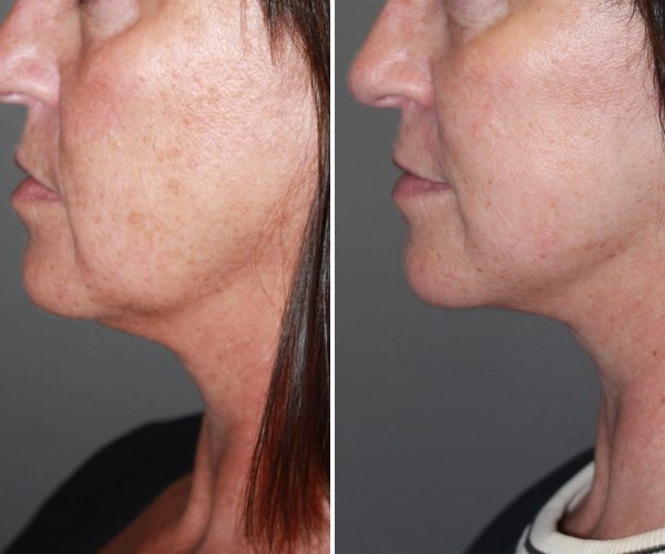 Skin rejuvenation