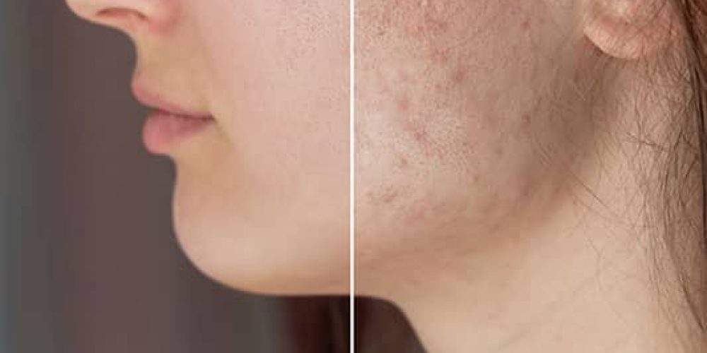 laser for acne Eevara
